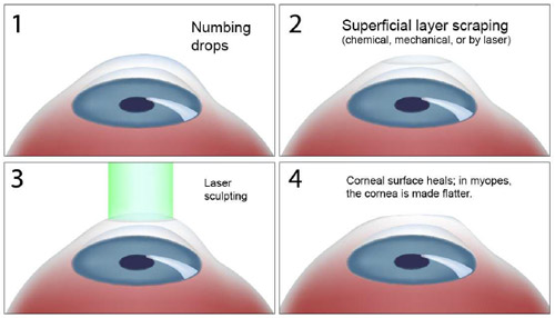 Advanced Lasik Surgery In Austin: Enhance Your Vision